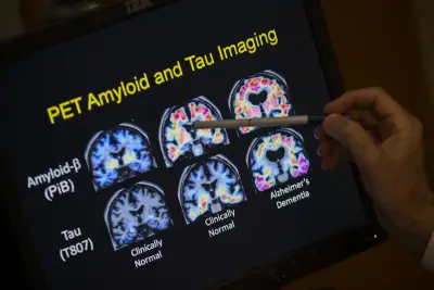 FDA approves blood test that can help diagnose Alzheimer’s disease
